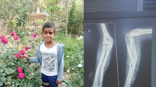 मुलाने गमावला हात