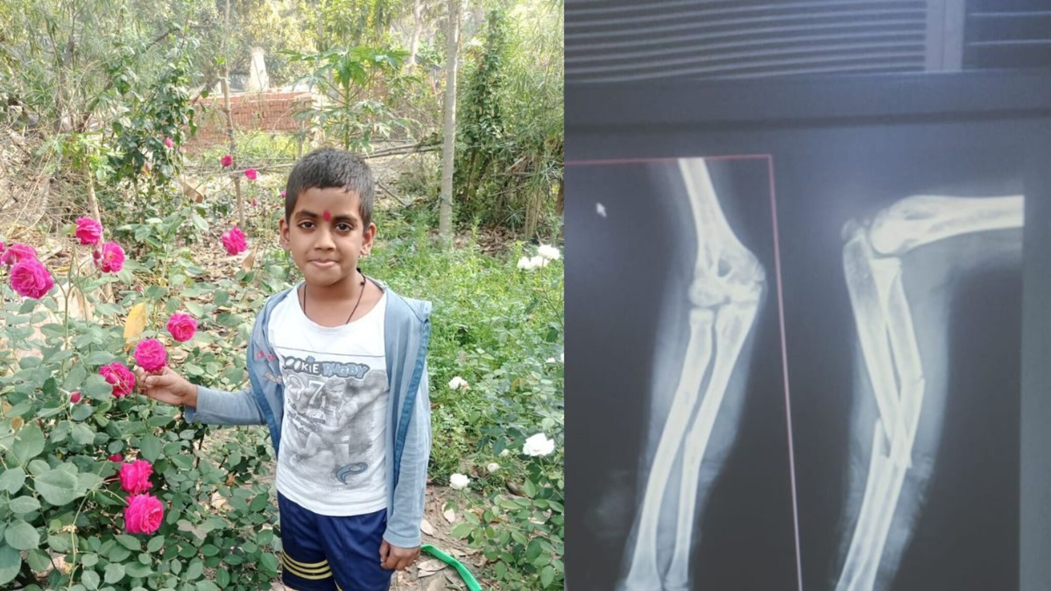 प्लॅस्टर लावलं आणि कायमचा 'गायब' झाला मुलाचा हात; कळवा रुग्णालयात घडला धक्कादायक प्रकार