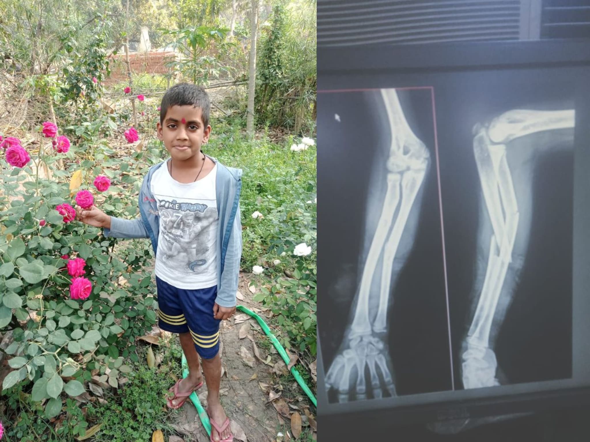 प्लॅस्टर लावलं आणि कायमचा 'गायब' झाला मुलाचा हात; कळवा रुग्णालयात घडला धक्कादायक प्रकार