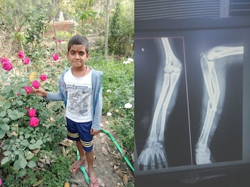 मुलाने गमावला हात मुलाने गमावला हात