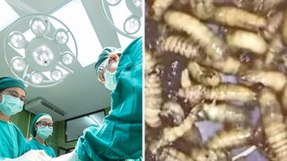 व्यक्तीच्या नाकातून काढल्या 150 जिवंत अळ्या