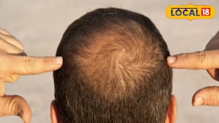 अनेक आशियाई देशांमध्ये प्राचीन काळापासून हा उपाय केला जातो. अनेक आशियाई देशांमध्ये प्राचीन काळापासून हा उपाय केला जातो.