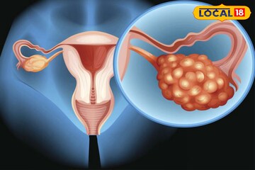 PCOD समस्या असणाऱ्या महिलांचा आहार कसा असावा? पाहा आहार तज्ज्ञांचा सल्ला