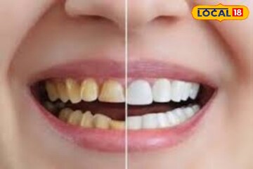 80 वर्षातही दात हिऱ्यासारखे चमकतील! डॉक्टरांनी सांगितलं जबरदस्त Solution 80 वर्षातही दात हिऱ्यासारखे चमकतील! डॉक्टरांनी सांगितलं जबरदस्त Solution