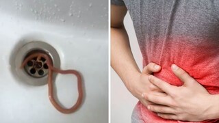 पोटदुखी मग झाली उलटी, व्यक्तीच्या पोटातून बाहेर आला जिवंत किडा