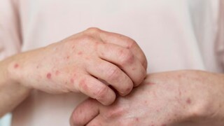 मंकीपॉक्स हा आजार काय आहे, त्याची लक्षणे काय आहेत आणि त्यापासून बचाव कसा करावा हे जाणून घेणे आवश्यक आहे. 