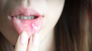 तोंड आलं असेल तर करा हे घरगुती उपाय 