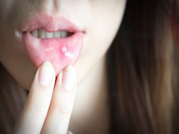 तोंड आलं असेल तर करा हे घरगुती उपाय 