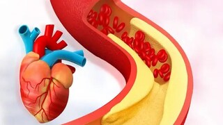 increases cholesterol do not make these mistakes