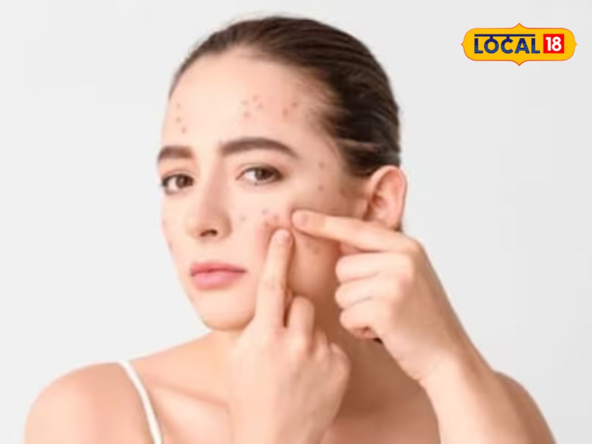 पिंपल्स असलेल्या त्वचेची हिवाळ्यात काळजी कशी घ्यायची? डॉक्टरांनी दिला सल्ला