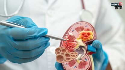 प्रतिकात्मक फोटो : हिवाळ्यात वाढतो किडनी स्टोनचा धोका, बदला ‘या' सवयी
