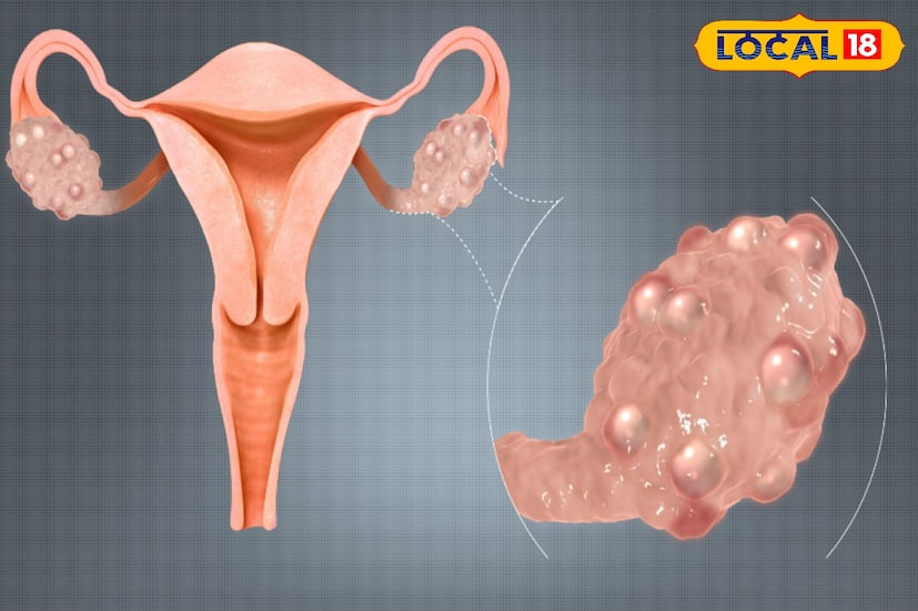 डॉ. पुनम बहुरूपी यांनी दिलेल्या माहितीनुसार, PCOD आणि PCOS या दोन्ही आजारांची लक्षणं जवळपास सारखीच आहेत. यांवर वेळीच उपचार न केल्यास गर्भधारणेत अडचणी निर्माण होऊ शकतात, शिवाय या आजारांचा परिणाम वजन, केस, त्वचा इत्यादी पूर्ण आरोग्यावर दिसून येतो. हळूहळू गर्भाशयात गाठीही तयार होऊ शकतात. ज्यामुळे त्वचेवर अनावश्यक केसांची वाढ होते, लठ्ठपणाही वाढू शकतो.