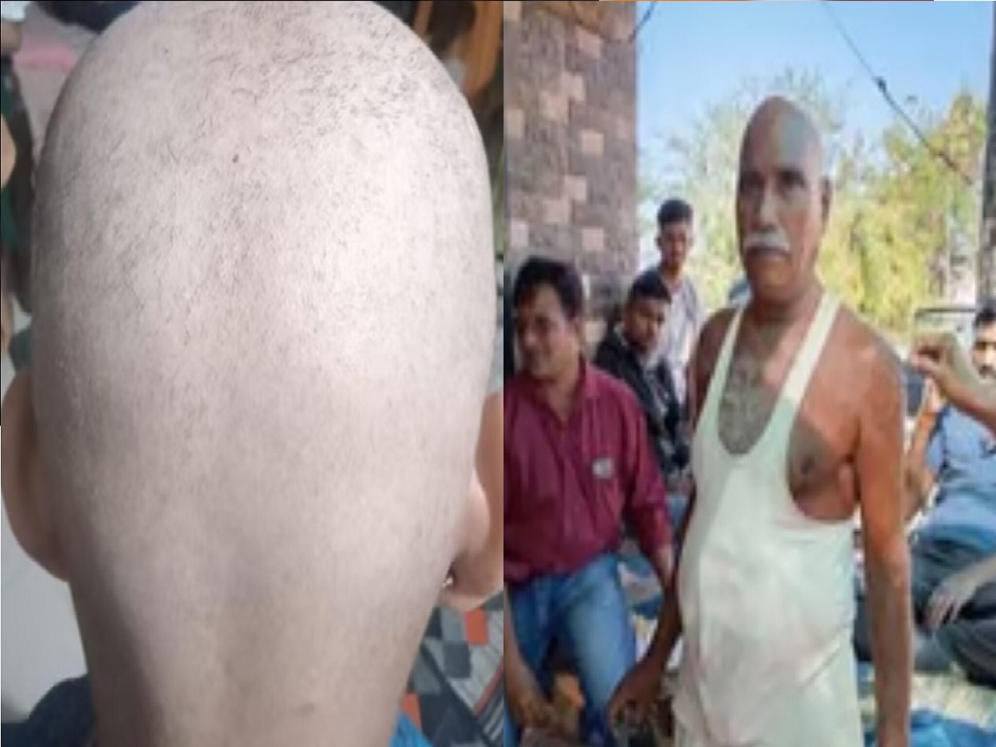 Buladhana Takkal Virus : बुलढाण्यात टक्कल व्हायरस काय थांबेना! शेगावनंतर 'या' तालुक्यात शिरकाव,नागरीकांमध्ये भितीचे वातावरण