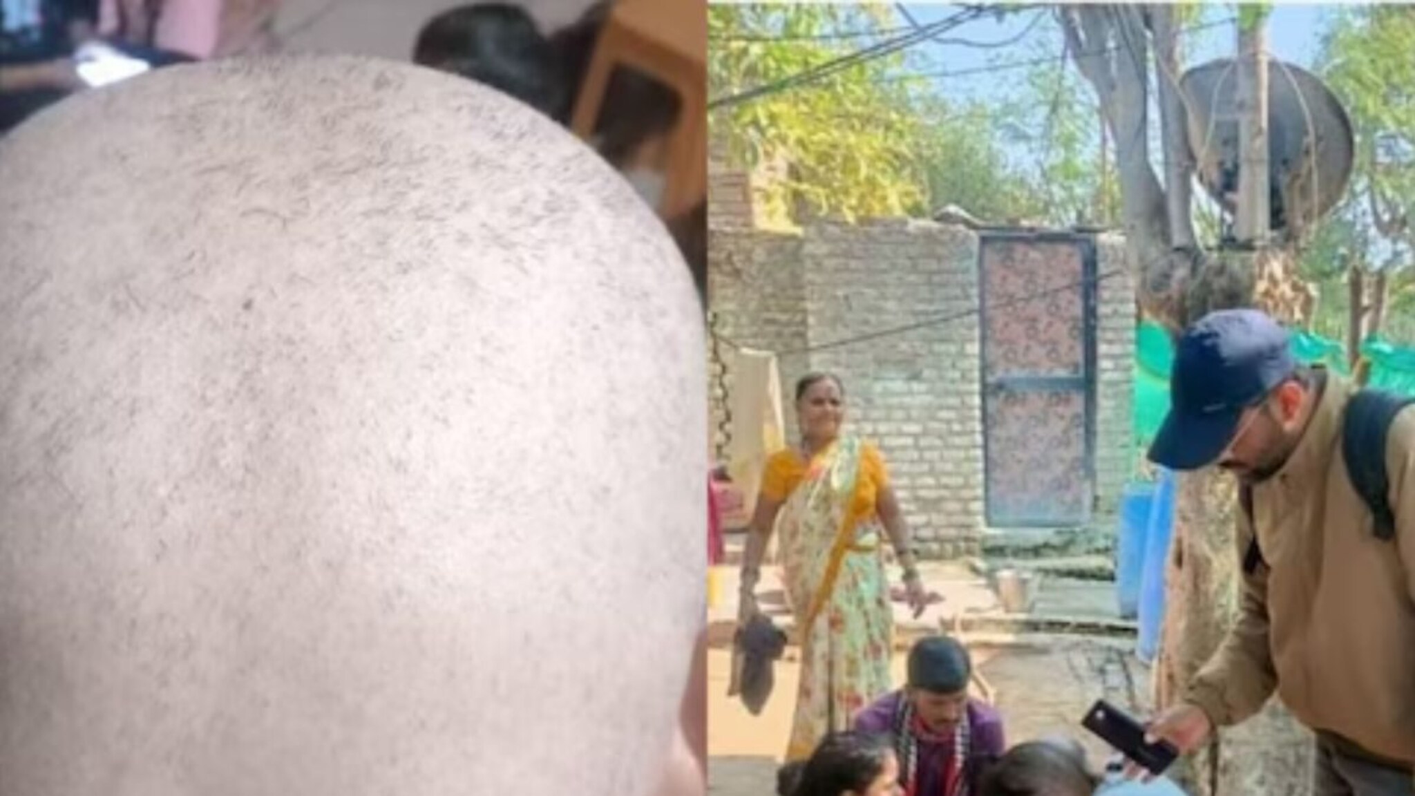 'टक्कल व्हायरस'ने ग्रस्त रुग्णांची चिंता मिटली! परत येऊ लागली केसं, कसा झाला चमत्कार? आरोग्य मंत्र्यांनीच सांगितलं