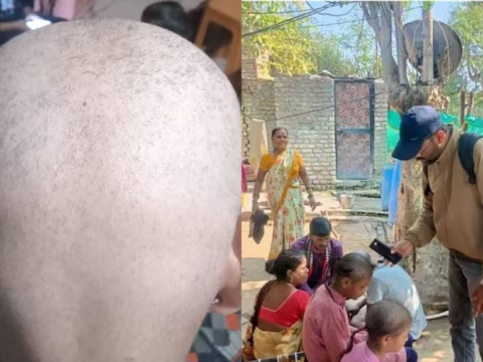 'टक्कल व्हायरस'ने ग्रस्त रुग्णांची चिंता मिटली! परत येऊ लागली केसं, कसा झाला चमत्कार? आरोग्य मंत्र्यांनीच सांगितलं