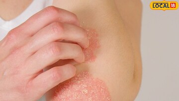 सोरायसिस