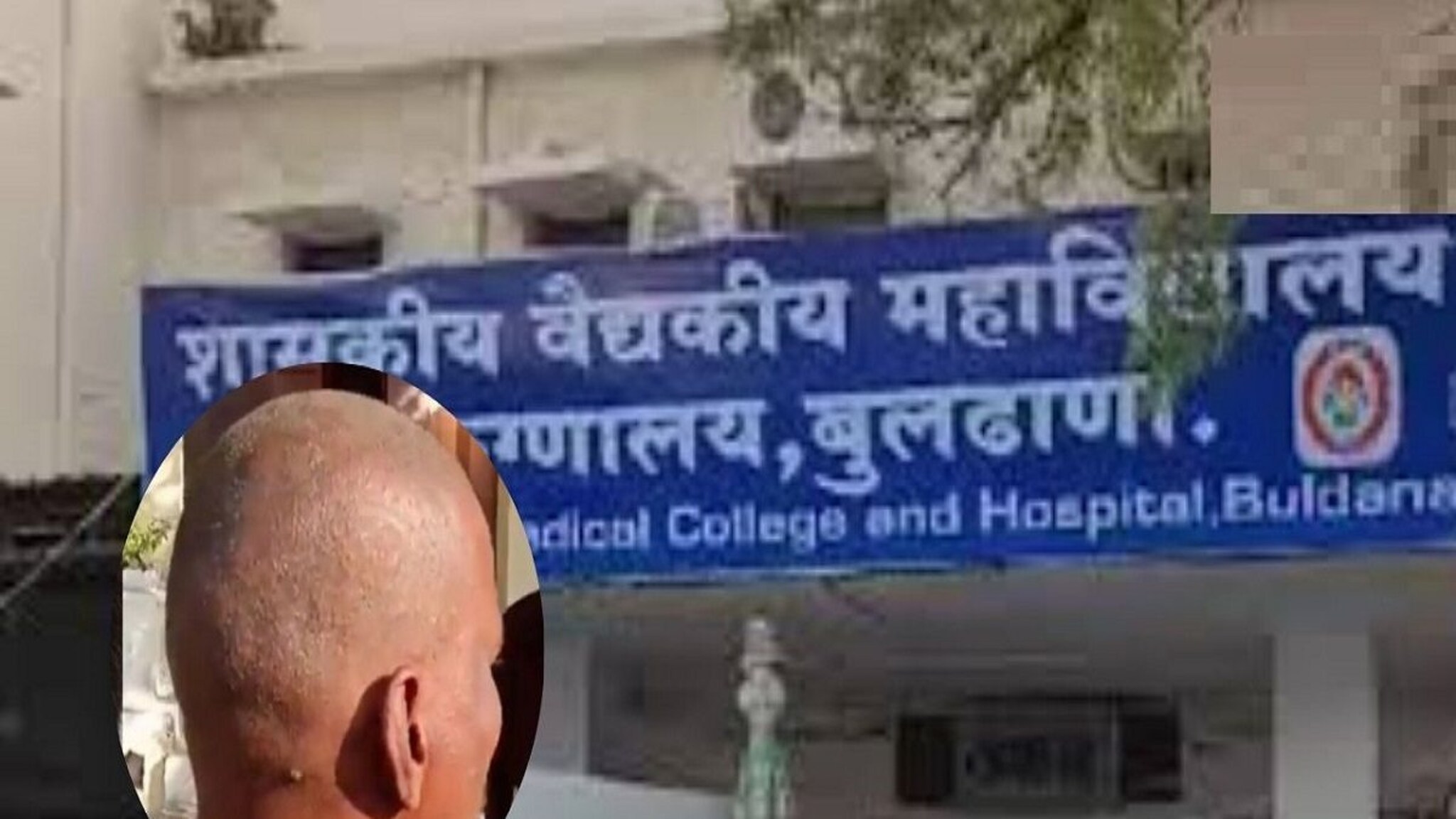 Buldhana: बुलढाण्यात 'टक्कल व्हायरस'नंतर 'ब्ल्यू बेबी सिंड्रोम'ची दहशत! नेमका आजार काय, धोका कुणाला?