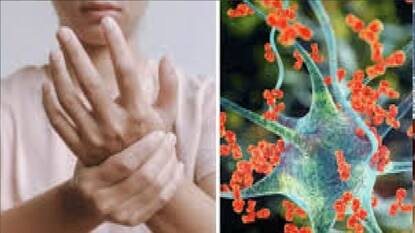 guillain barre syndrome guillain barre syndrome