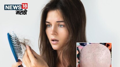 Buldhana causes rapid hair loss