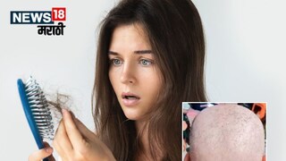 Buldhana causes rapid hair loss Buldhana causes rapid hair loss