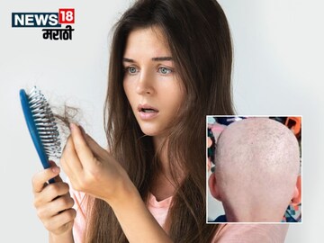 Buldhana causes rapid hair loss Buldhana causes rapid hair loss