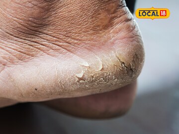 पायांच्या भेगांनी त्रस्त आहात? रात्री झोपण्यापूर्वी लावा 'हे' तेल...