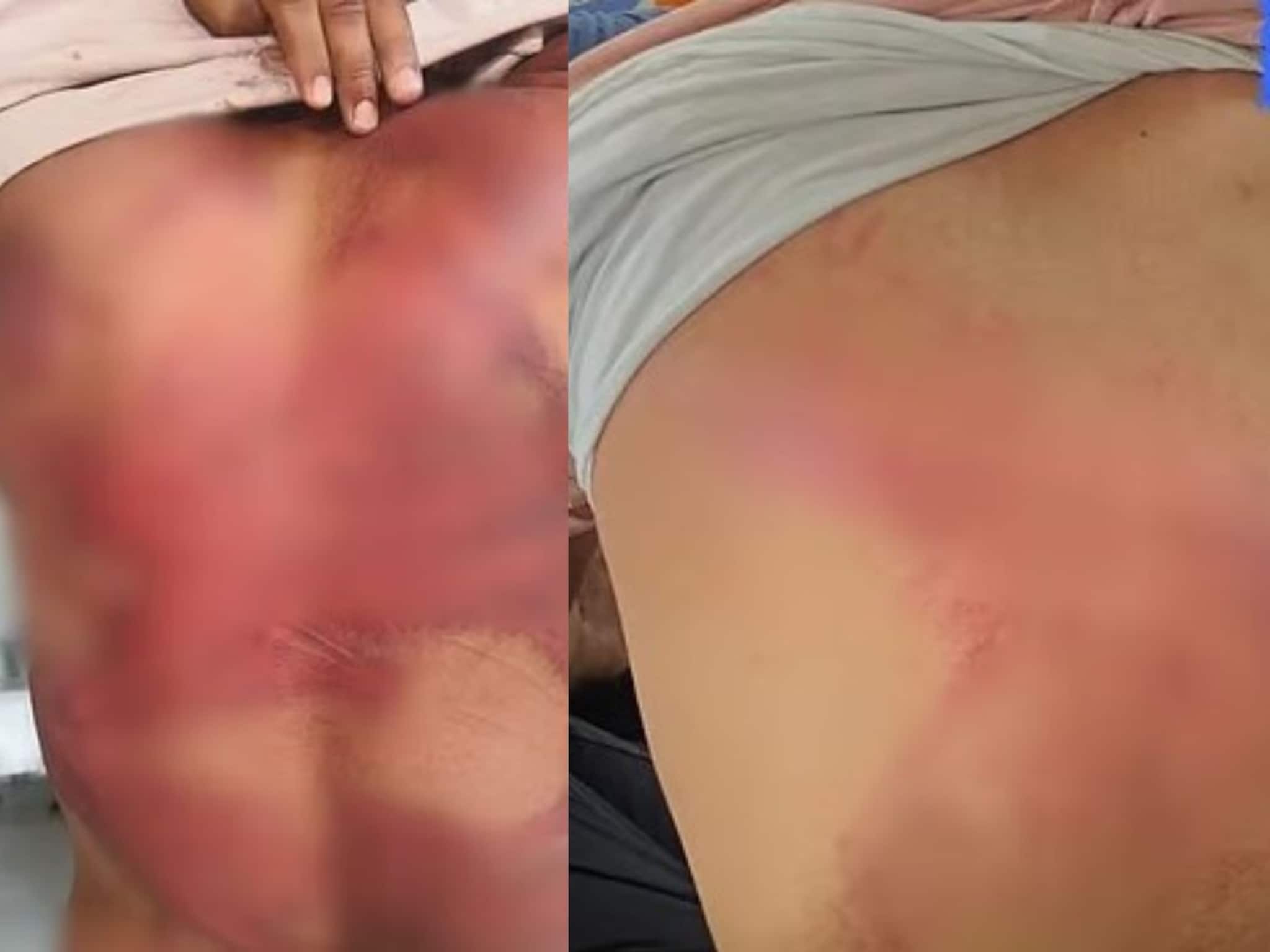 उघड्यावर लघुशंका केल्याने पाठ सोलेपर्यंत मारलं, लोखंडी रॉड, गजाने मारहाण