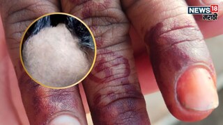 Buldhana Rapid Nails Loss