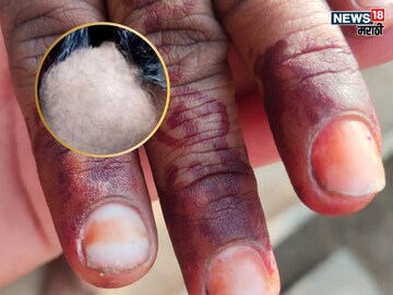 Buldhana Rapid Nails Loss