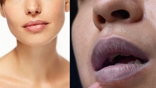 Lip health Lip health