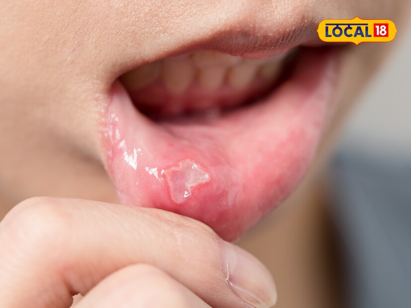  सर्वात आधी, झेंडूच्या (मेरीगोल्ड) रोपाची 4 ते 5 हिरवी पाने कुस्करून त्याचा रस काढा. हा रस 2 थेंब कानात टाका. 10 मिनिटांपर्यंत हा रस कानात तसाच ठेवा. यावेळी तोंड हलवत राहा.