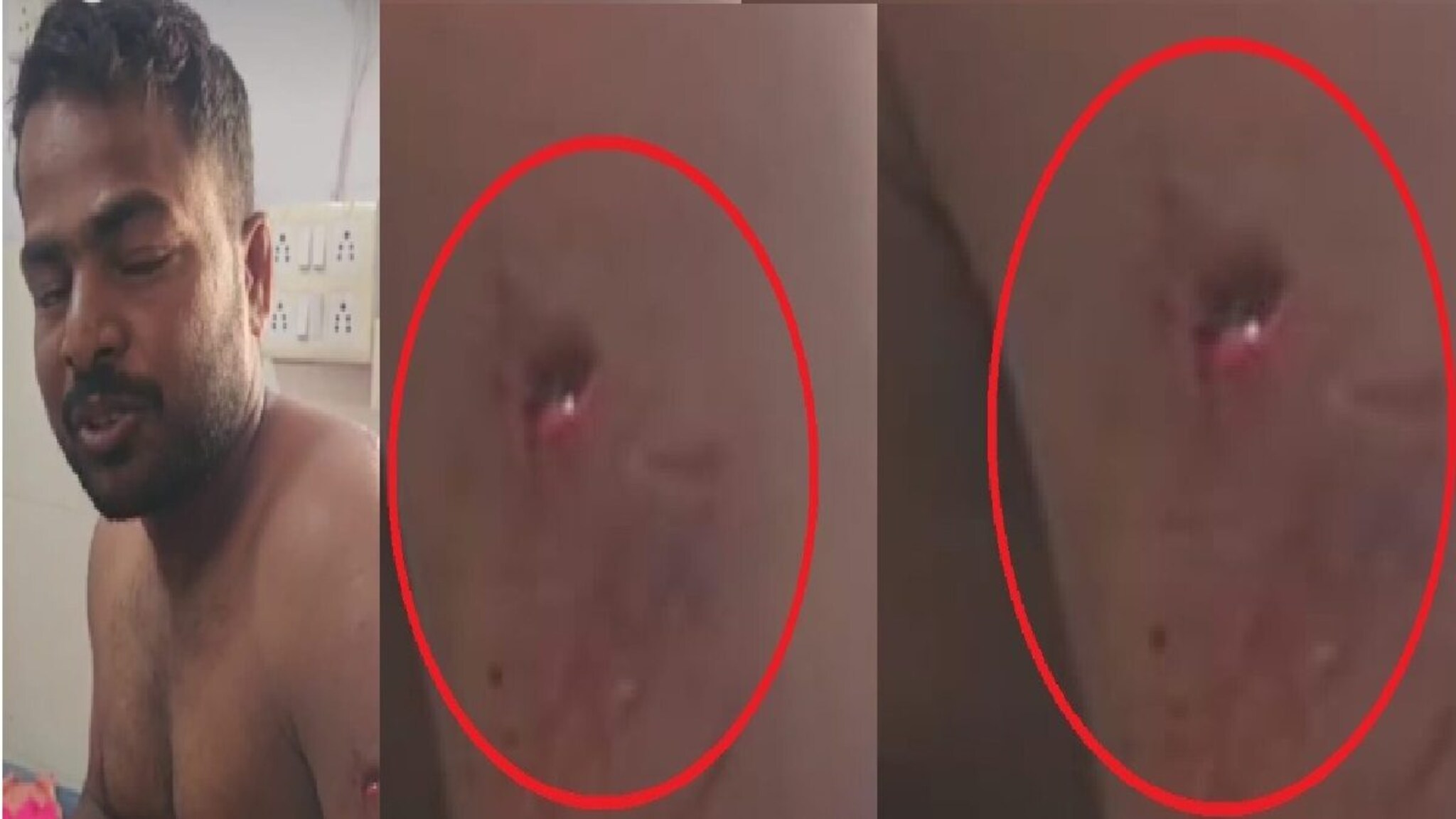 नखांचे खोलवर वार, दंडावर ओरखडे पण स्टील बॉडीसमोर हल्लाही फेल, बिबट्याच्या तावडीतून 'असा' सुटला तरुण!