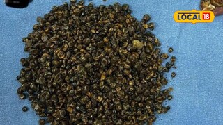 Gallstones Gallstones