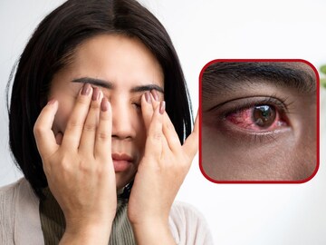 डोळ्यांच्या संसर्गापासून वाचण्यासाठी टिप्स