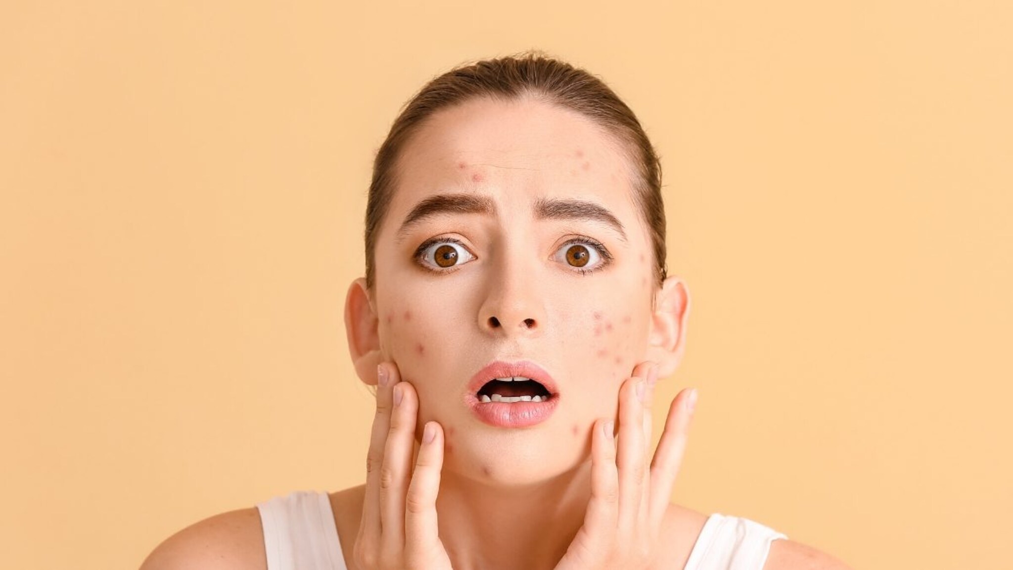 चेहऱ्यावरील पिंपल्समुळे वैतागलात? आजपासून फाॅलो करा 'या' 8 टिप्स; त्वचा होईल गुळगुळीत आणि स्वच्छ!