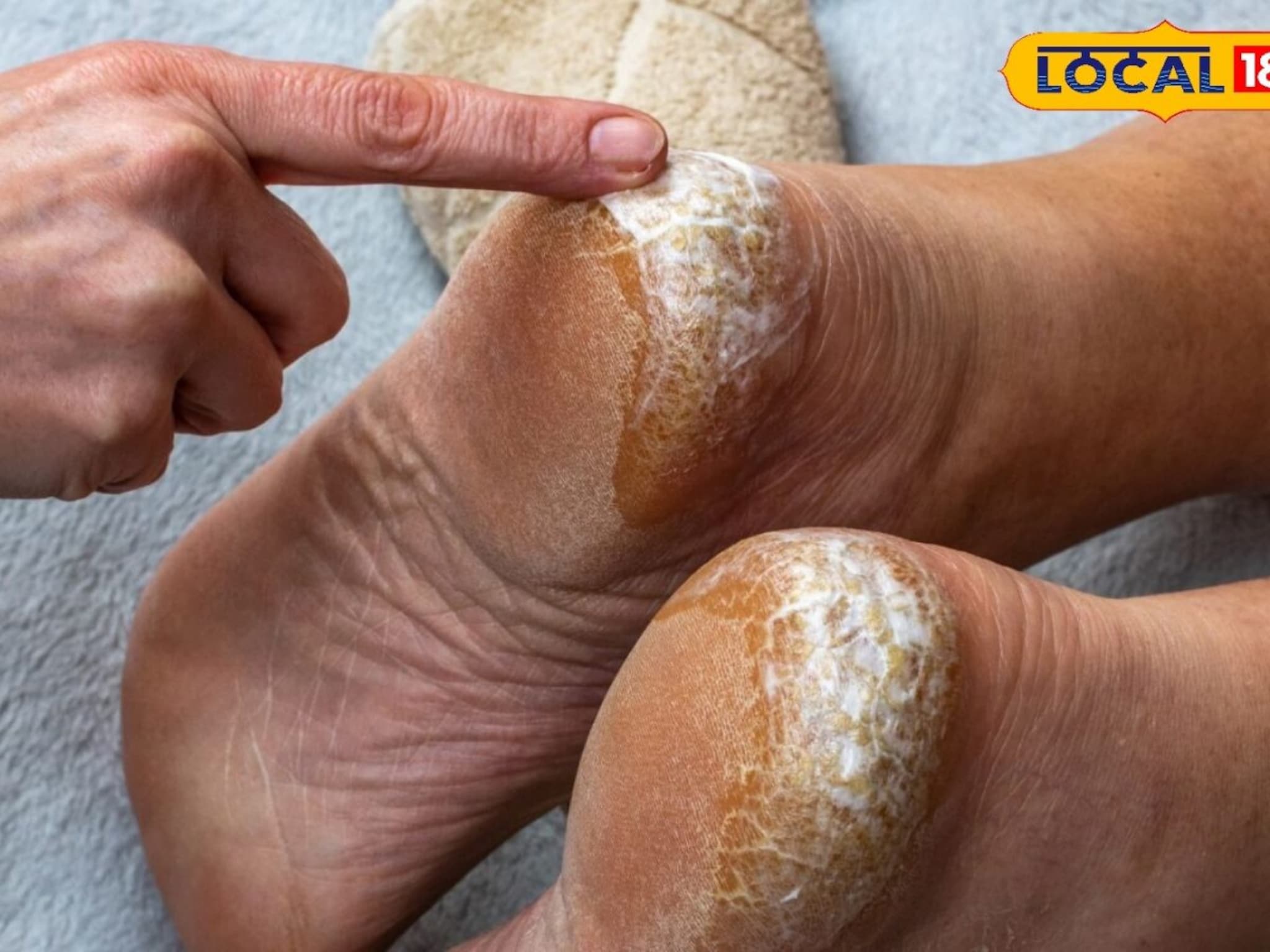 Cracked heels : टाचांना भेगा पडायला सुरुवात झालीय? आत्ताच करा हा उपाय, मऊ राहतील पाय