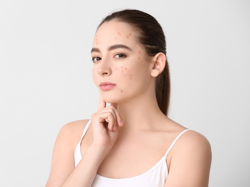  Skin care routine for acne-prone skin: मुरुमांची (पिंपल्स) समस्या जगभरातील लाखो लोकांना भेडसावते. यात चेहऱ्यावर, छातीवर आणि पाठीवर ब्लॅकहेड्स, व्हाईटहेड्स, पिंपल्स आणि गाठी येतात. हार्मोनल असंतुलन, आनुवंशिकता, ताणतणाव आणि पर्यावरणाचे घटक अशा अनेक कारणांमुळे त्वचेवर मुरुम येऊ शकतात.