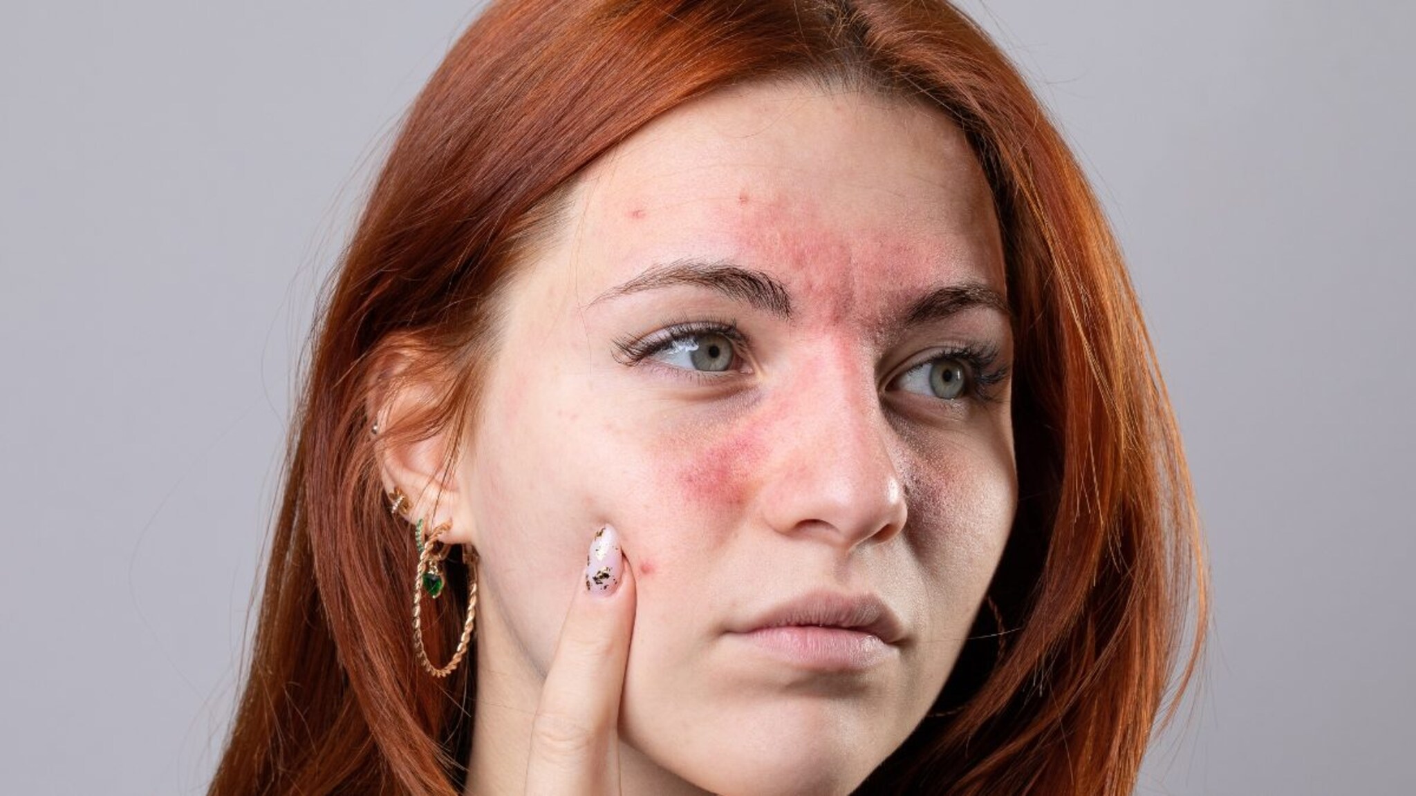 PCOD मुळे त्वचेच्या समस्या? आहारात करा 'हे' मुख्य बदल, त्वचा होईल निरोगी अन् चमकदार! तज्ज्ञ सांगतात...