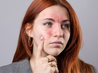 Skin problems due to PCOS