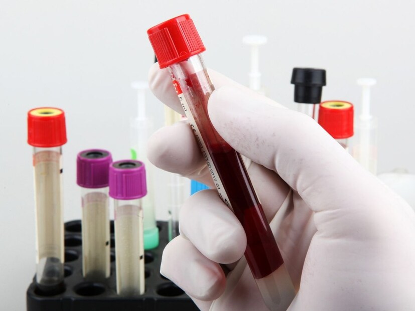BRCA जनुकीय चाचणी : यामध्ये BRCA1 आणि BRCA2 जनुके ओळखली जातात. हे दोन्ही जीन्स स्तन आणि अंडाशयाच्या कर्करोगासाठी जबाबदार आहेत.