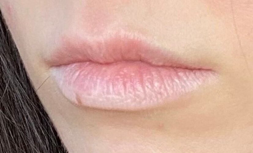 पांढरे ओठ: काही लोकांचे ओठ पांढरे किंवा गुलाबी तेलकट होऊ लागतात. हे अजिबात सामान्य नाही. पांढरे ओठ किंवा गुलाबी तेलकट ओठ हे शरीरातील अशक्तपणाचे लक्षण असू शकते. यासोबतच, रंगहीन किंवा पांढरे ओठ शरीरात पोषणाची कमतरता दर्शवतात.