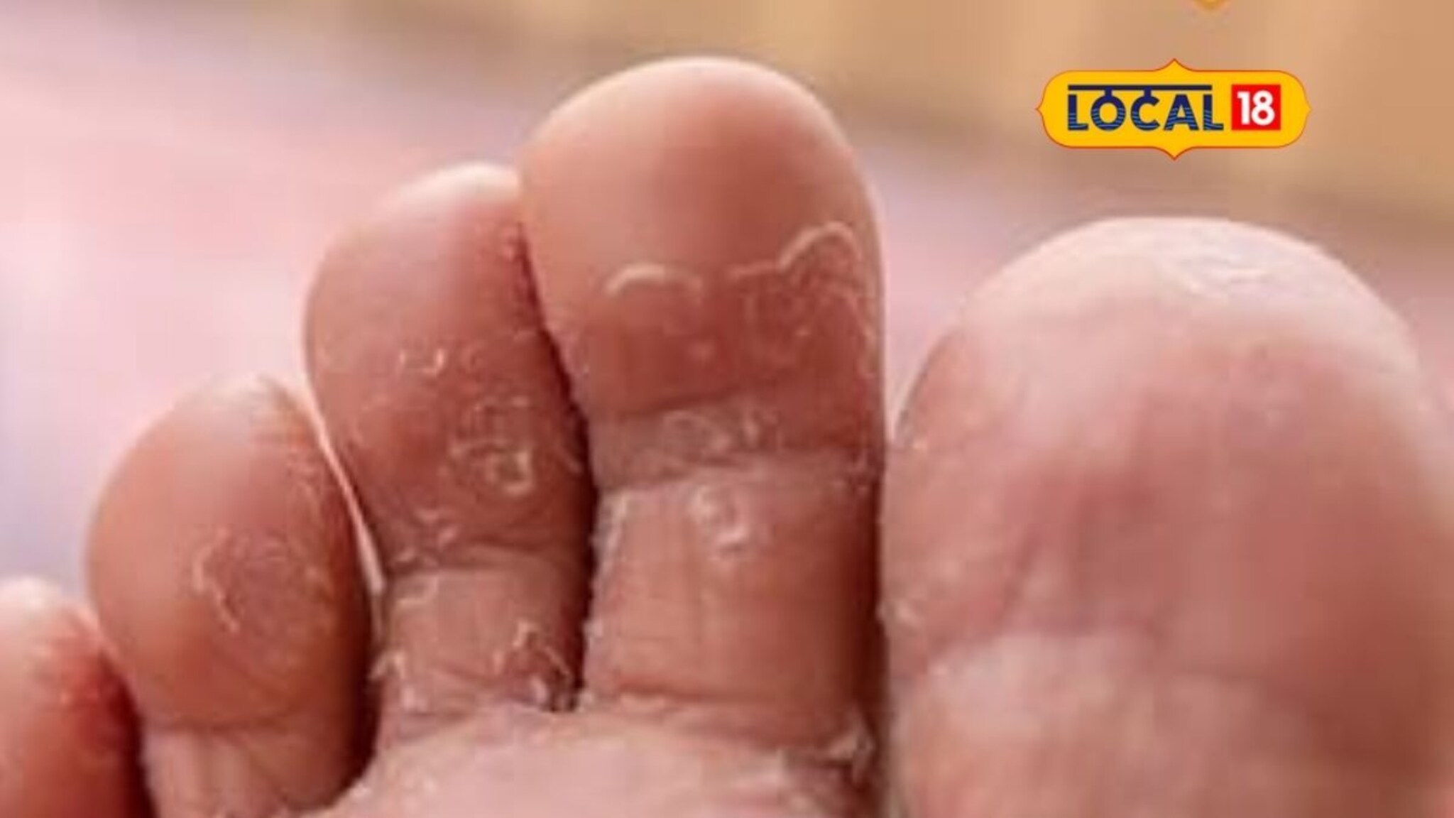 Health Tips: पावसाळ्यात साचलेल्या पाण्यातून जाणं तुमच्यासाठी धोकादायक, पायांना होतो हा गंभीर आजार!