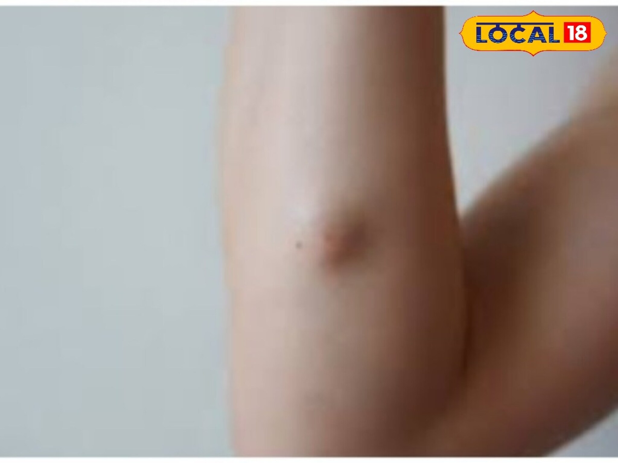 Lipoma Treatment : महागडी औषधं-शस्त्रक्रियेची गरजच नाही, या घरगुती उपायांनी लिपोमापासून व्हा मुक्त Lipoma Treatment : महागडी औषधं-शस्त्रक्रियेची गरजच नाही, या घरगुती उपायांनी लिपोमापासून व्हा मुक्त
