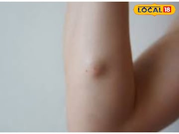 महागडी औषधं-शस्त्रक्रियेची गरजच नाही, या घरगुती उपायांनी लिपोमापासून व्हा मुक्त महागडी औषधं-शस्त्रक्रियेची गरजच नाही, या घरगुती उपायांनी लिपोमापासून व्हा मुक्त