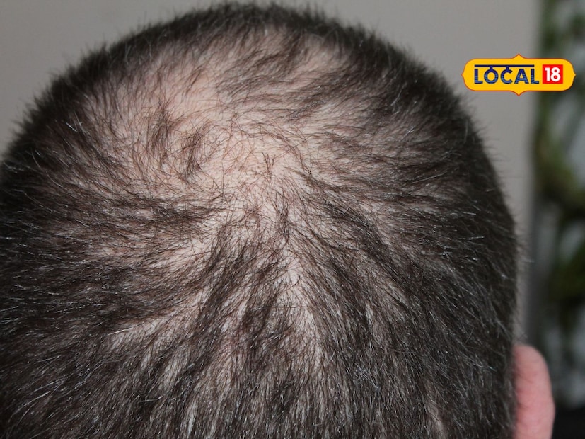  जर तुमची टाळू कोरडी पडली असेल, खाज येत असेल किंवा डोक्यात कोंडा झाला असेल तर तुम्ही भृंगराजमुळे याला आराम मिळू शकतो. यामुळे टाळू मॉइश्चरायझ होतो आणि केसांची वाढ चांगली होण्यास मदत होते.