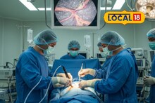 ﻿Heart Surgery: एकही टाका न घालता पार पडली हार्ट सर्जरी! पुण्यातील डॉक्टरांनी नेमकं केलं काय?