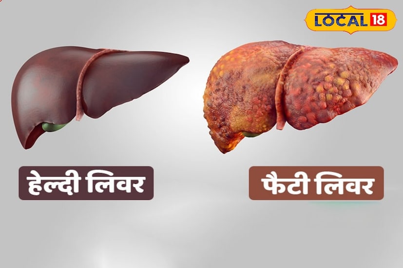फास्ट फूड आणि महागडे रेस्टॉरंटमधील पदार्थ चविष्ट असतात, परंतु ते शरीरासाठी तितकेच हानिकारक असतात. हे पदार्थ खाल्ल्याने लठ्ठपणा वाढतो, ज्यामुळे फॅटी लिव्हर होऊ शकते.