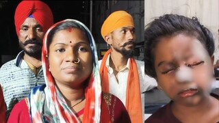 मुलाचे डोळे भाजले
