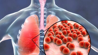 Lung Infection Lung Infection