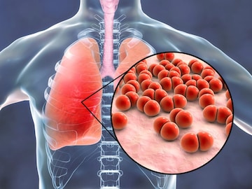 Lung Infection
